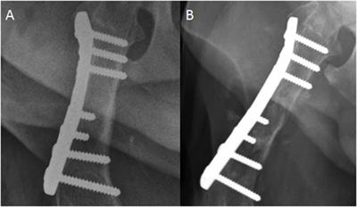 Long-term Formation of Aggressive Bony Lesions in Dogs with Mid-Diaphyseal Fractures Stabilized with Metallic Plates: Incidence in a Tertiary Referral Hospital Population